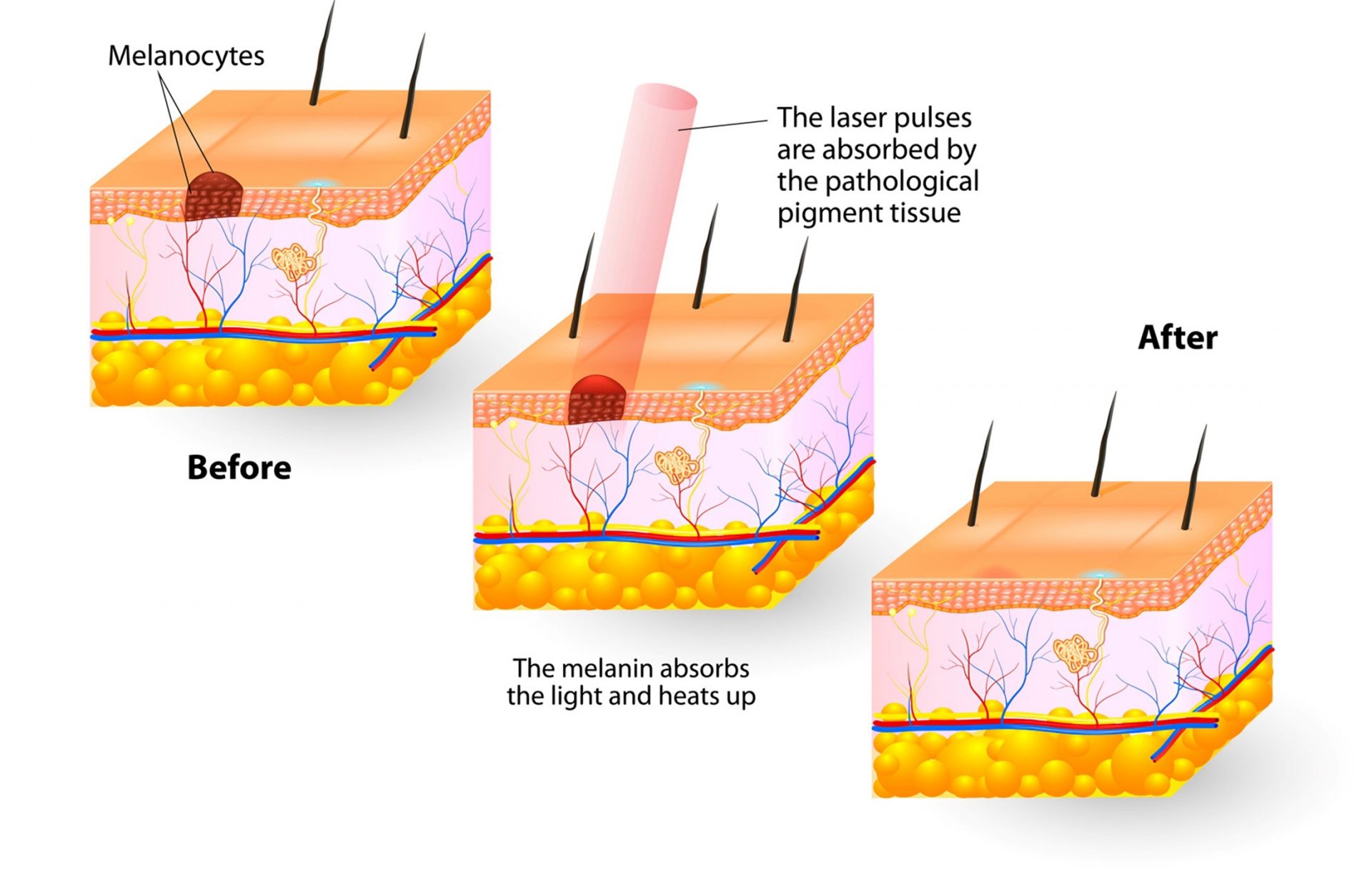 laser pigment removal treatment - how it works