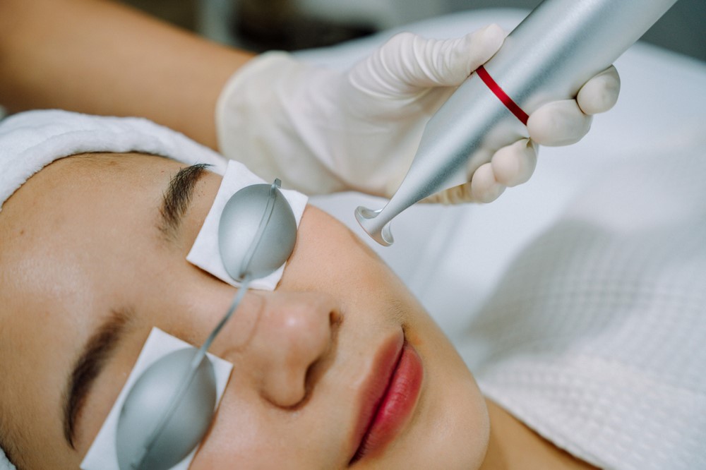 pigmentation laser treatment