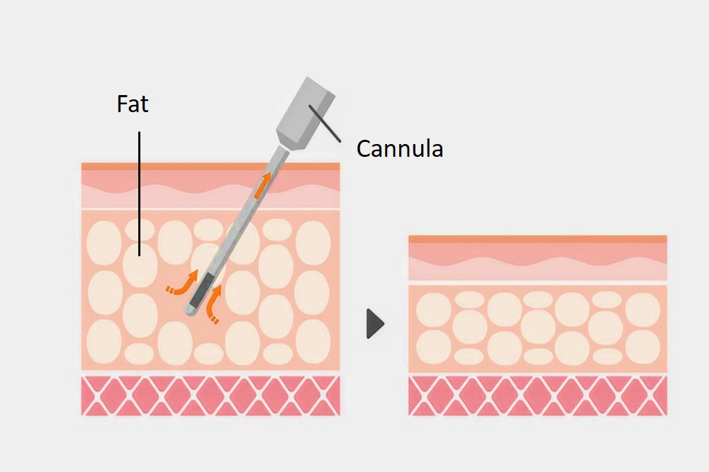 how liposuction works