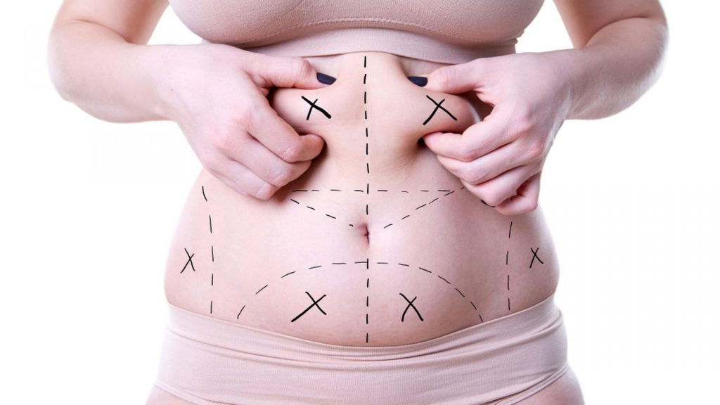 liposuction surgery what it can and cannot do