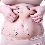 liposuction surgery what it can and cannot do