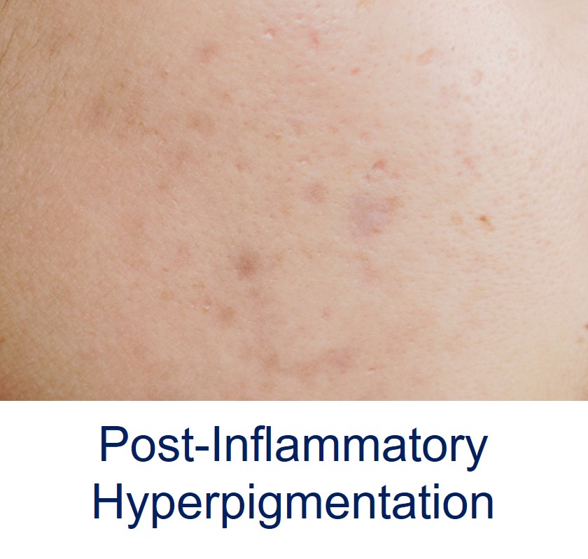 post-inflammatory hypigmentation