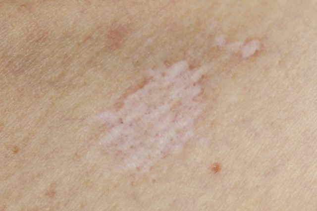 pih - skin becomes too light after laser treatment