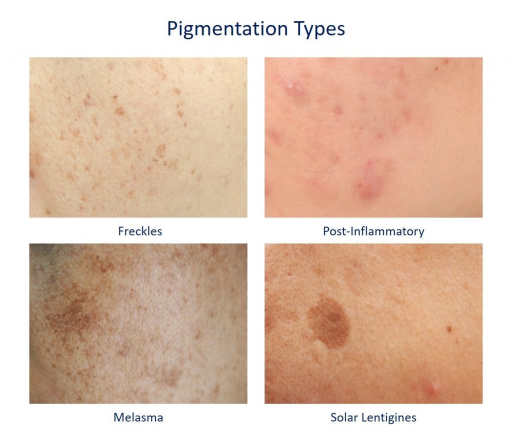 How to Remove Hyperpigmentation and Freckles – Tips and Treatment ...