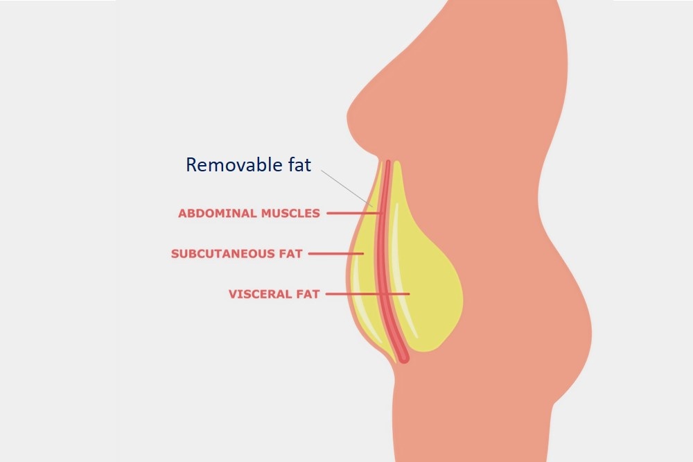 which fat can be removed with liposuction
