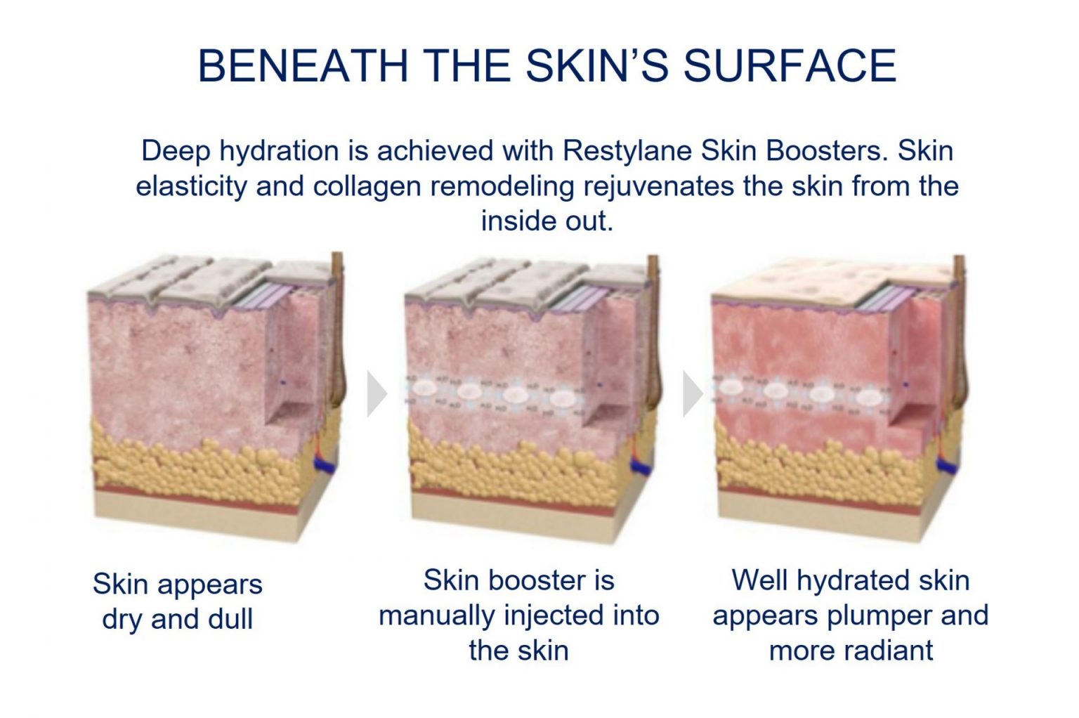 Restylane Skin Booster – How Effective Is the Treatment? | Dream ...