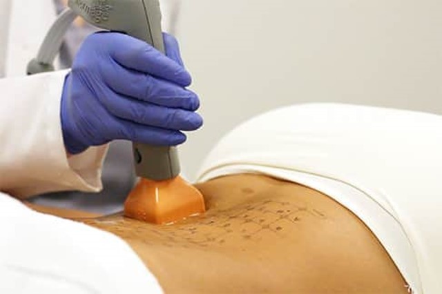 thermage body treatment