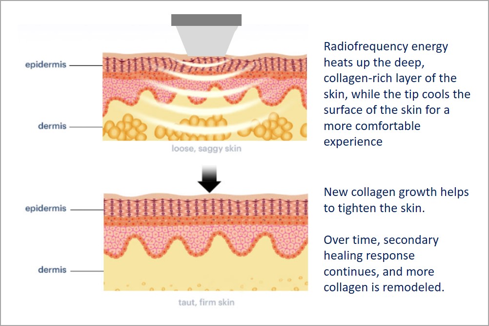 process of skin rejuvenation with thermage rf treatment