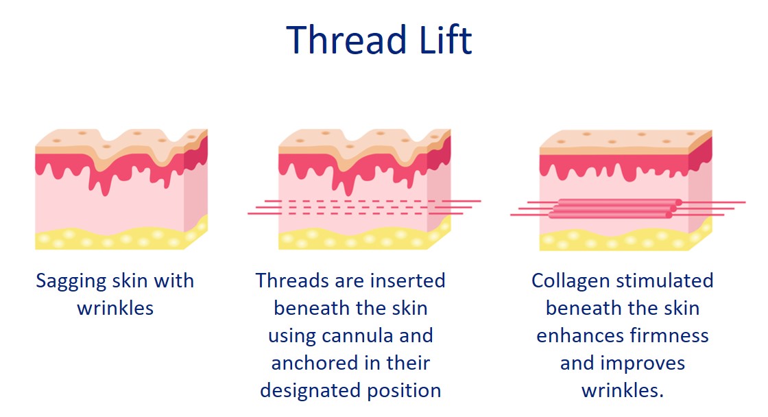 thread lifting process and how it works