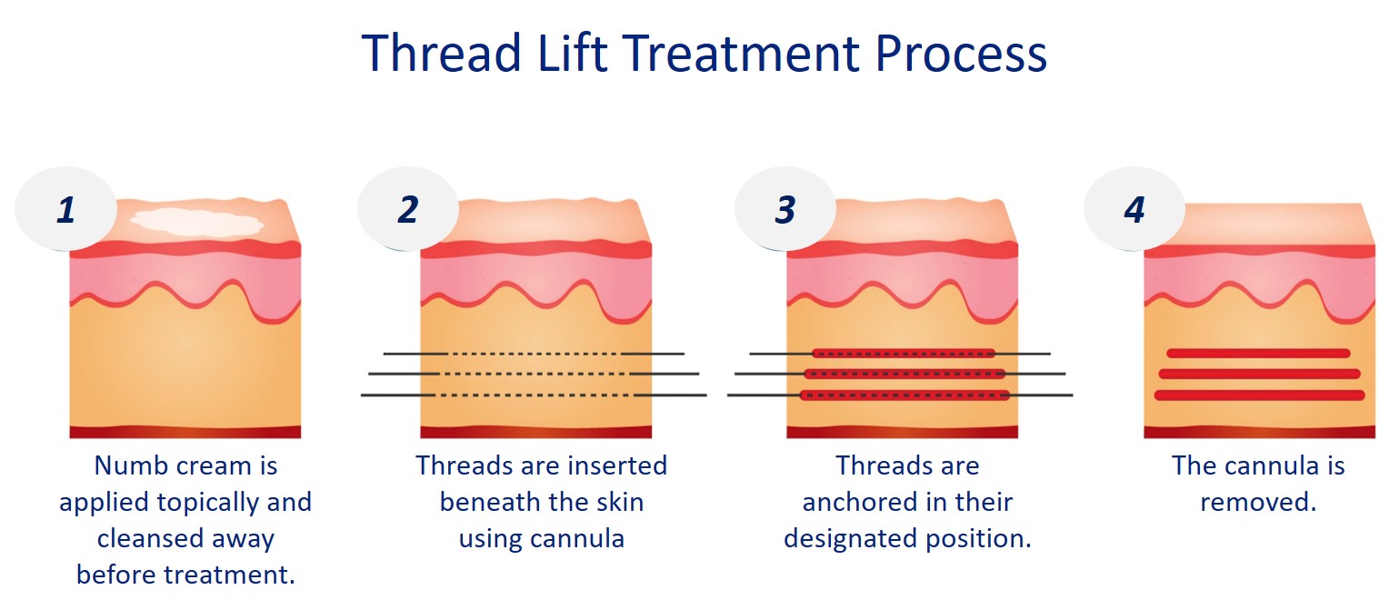 process of thread lift treatment