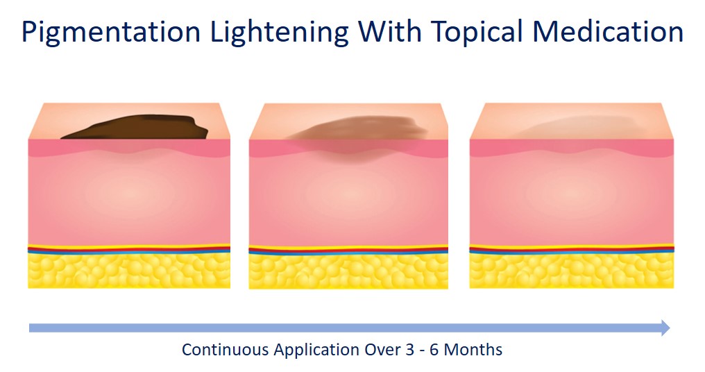 how topical cream helps to lighten pigmentation
