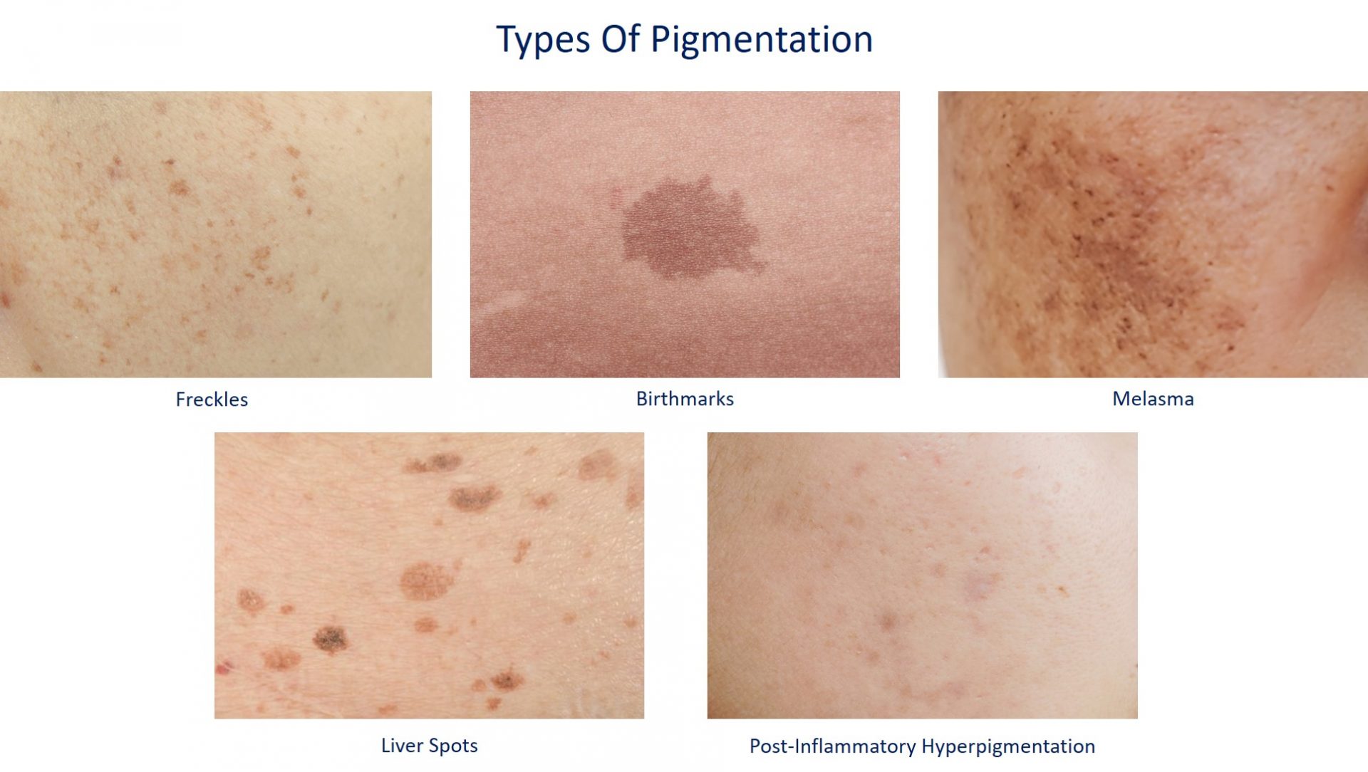 types of pigmentation concern
