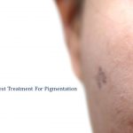 which is the best treatment for pigmentation