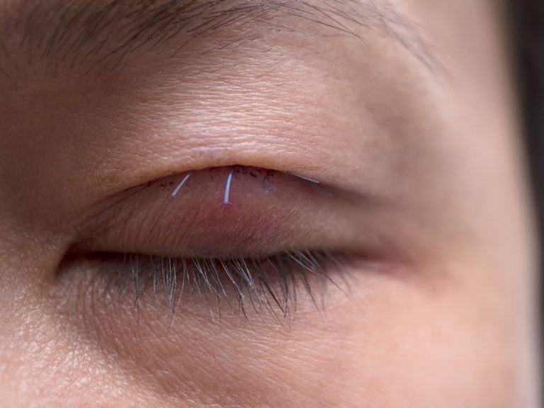 Nonincisional Double Eyelid Surgery The Scarless Technique for