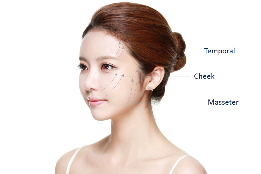 areas for face thread lift