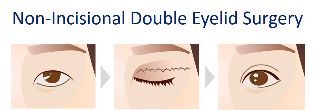 non-incisional double eyelid surgery