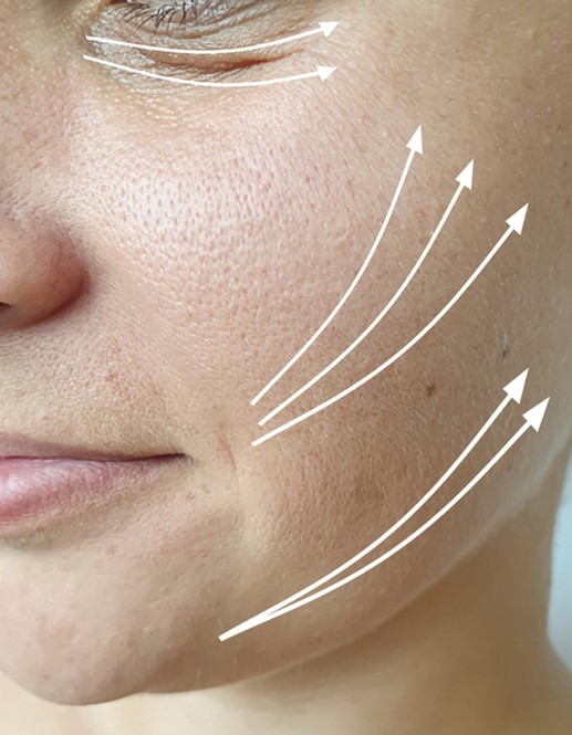 areas of the face for thread lifting