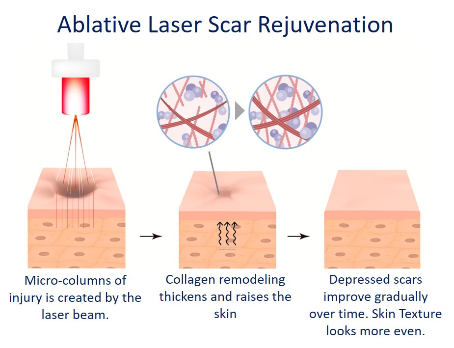 ablative laser for acne scar lightening - how it works