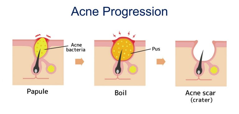 acne progression to scar