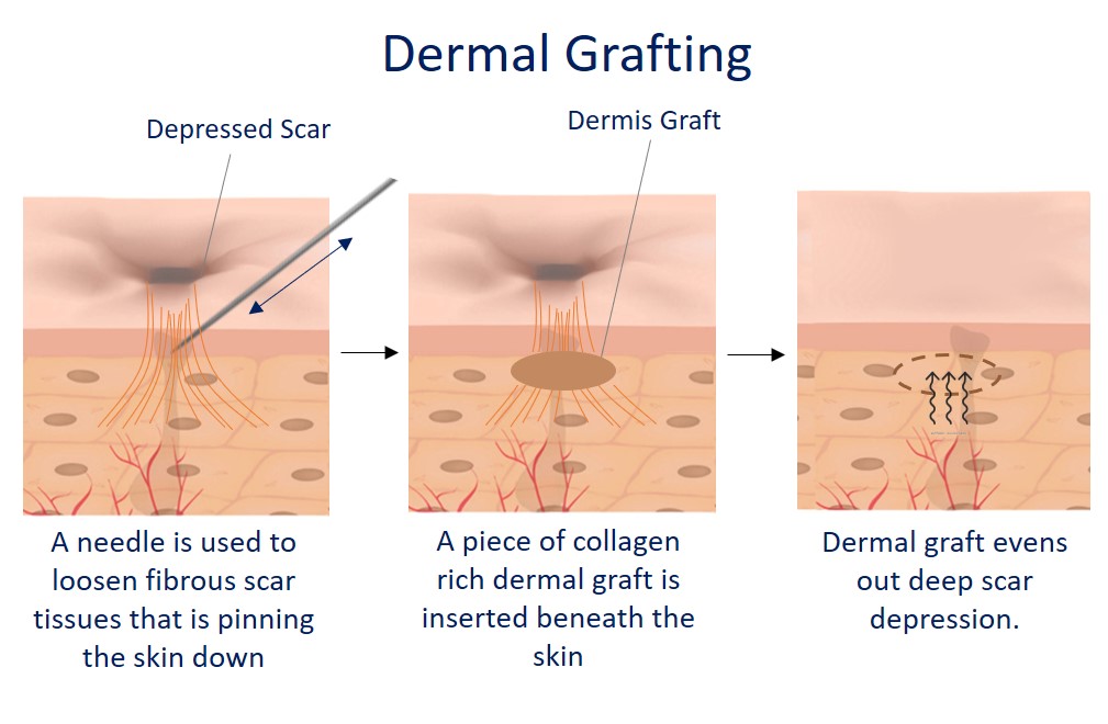 dermal grafting for depressed acne scar - how it works