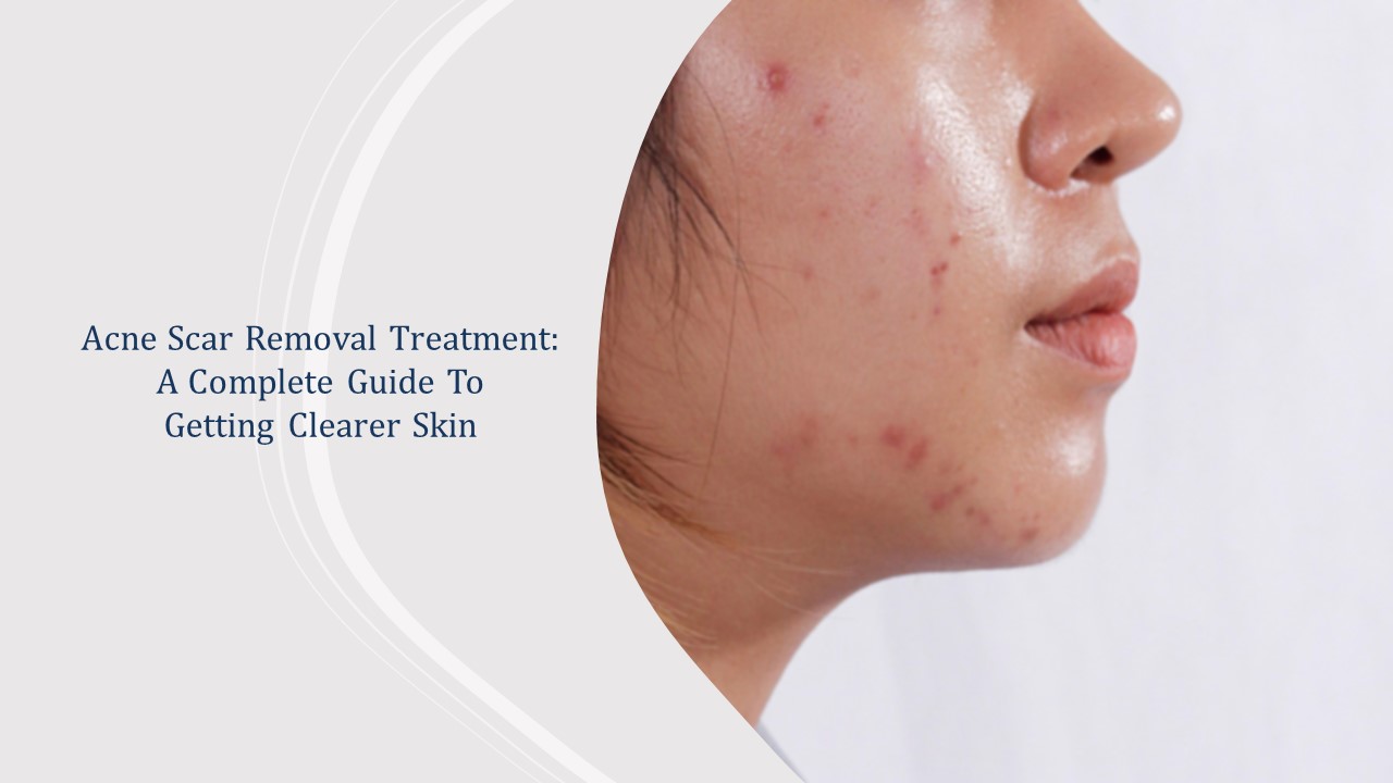 acne scar removal treatments - all you need to know - complete guide