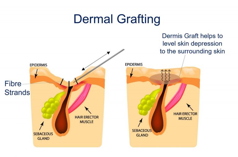 dermal graft for deep acne scars