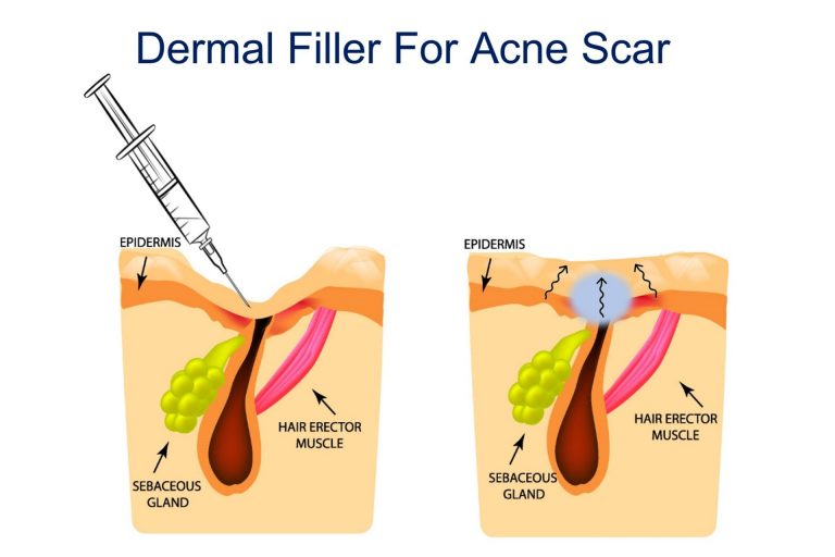 dermal filler for raising acne scar