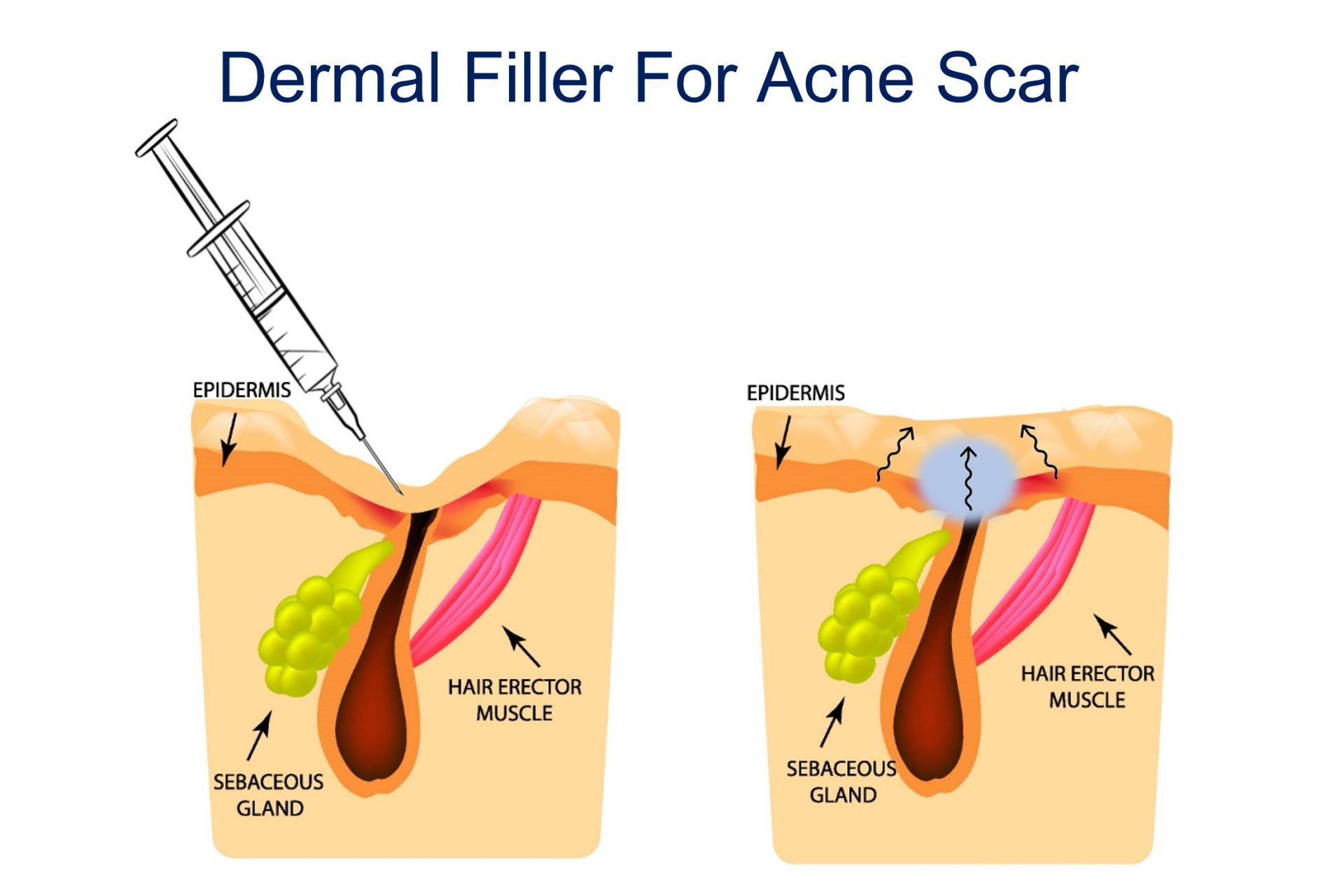 dermal filler for raising acne scar
