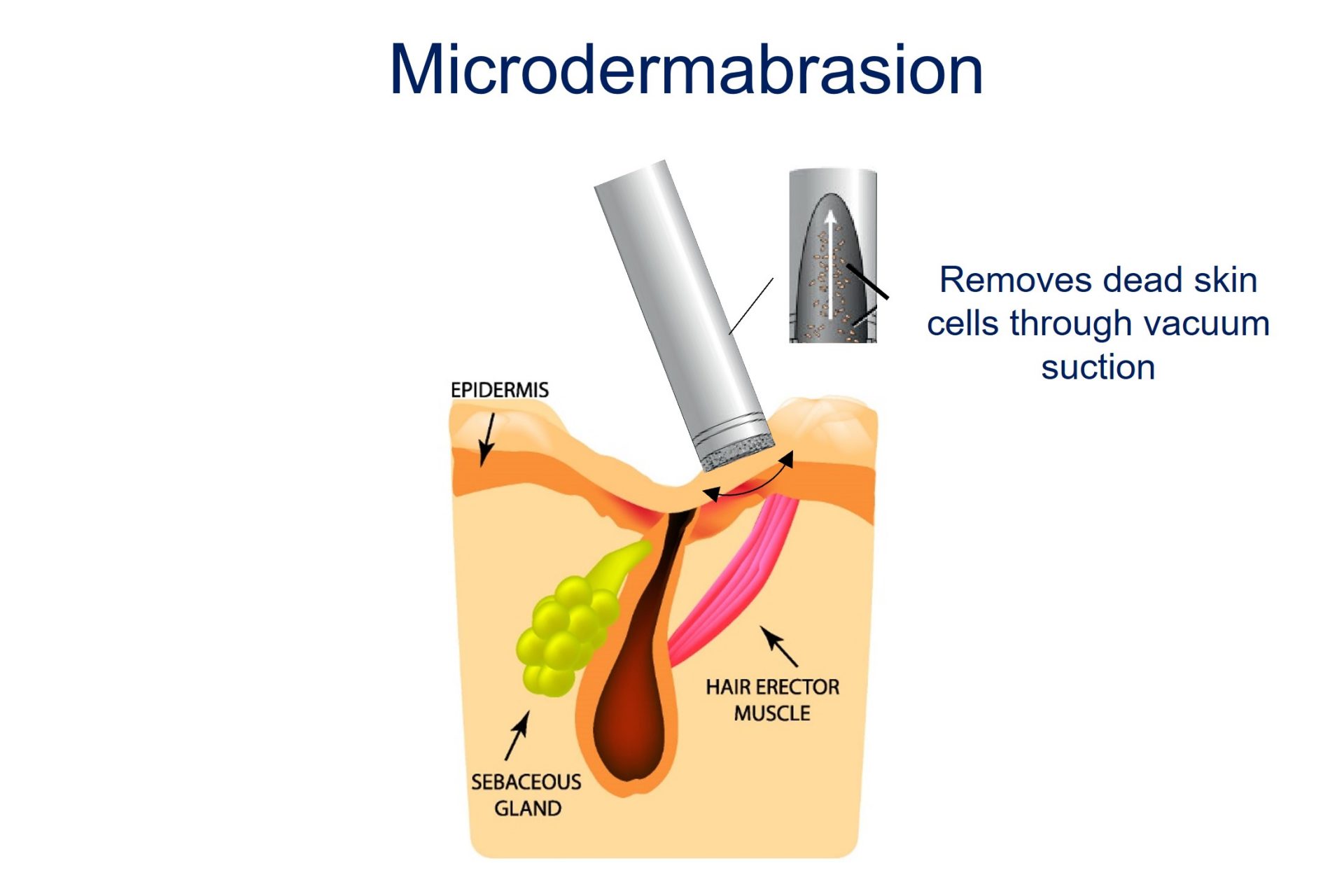 microdermabrasion for acne scar lightening