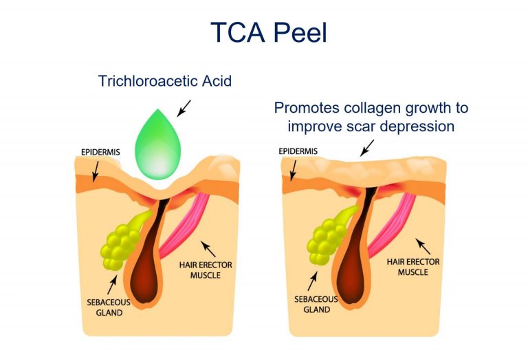 acid peel for ice pick scar