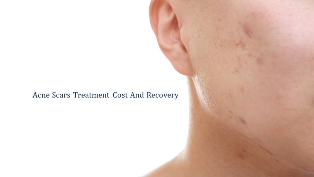 acne scar treatment cost in singapore