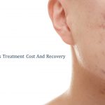 acne scar treatment cost in singapore