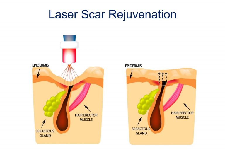 laser rejuvenation for acne scar