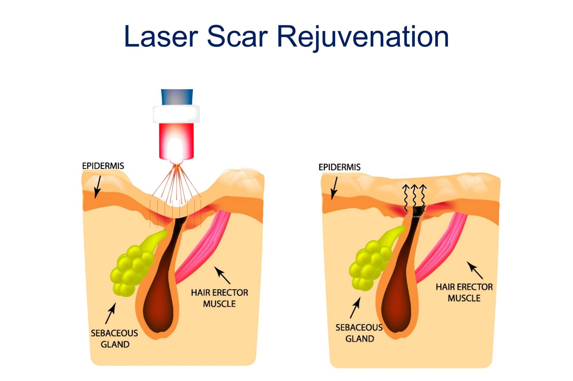 laser rejuvenation for acne scar