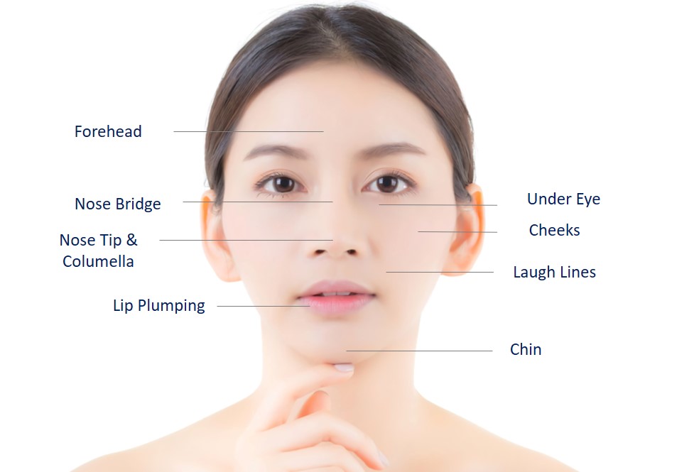 areas for facial dermal filler injection