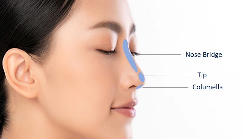 areas for nose filler enhancement