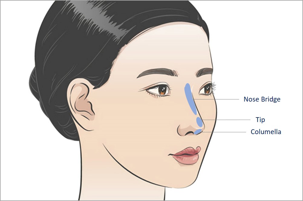 nose dermal filler treatment areas