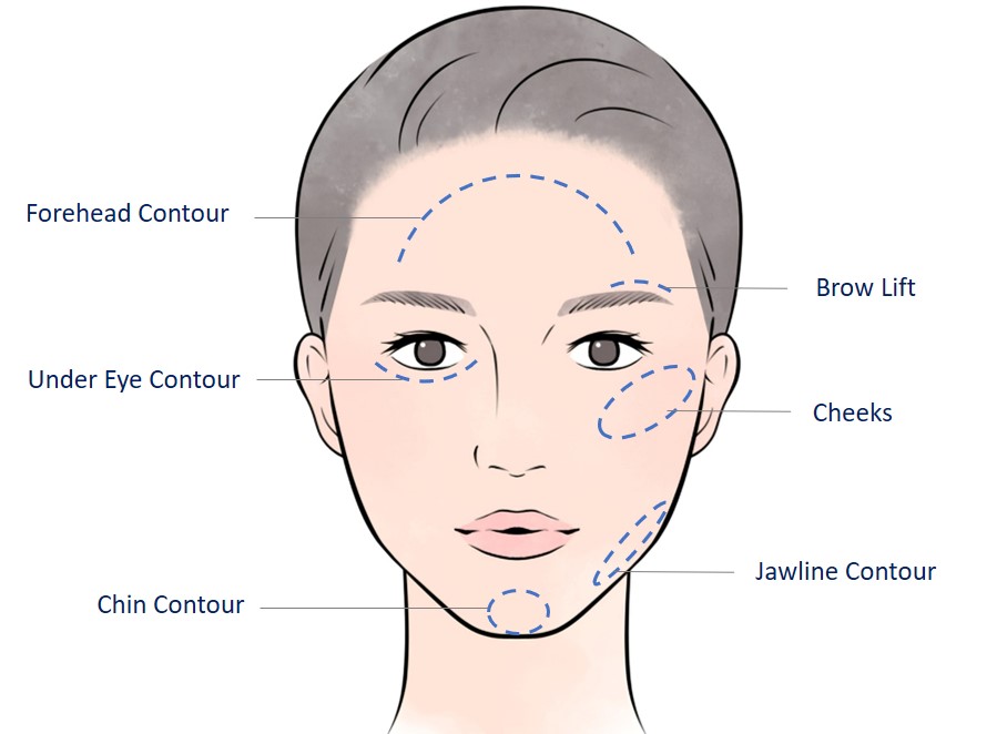 areas for filler contouring injection
