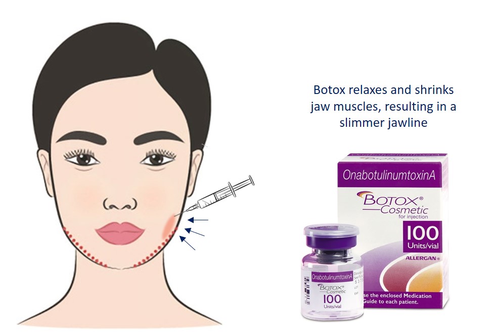 botox jaw facial slimming injection