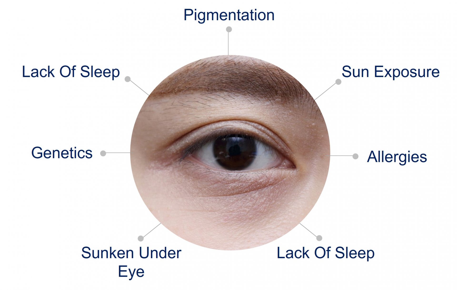causes of eye bag
