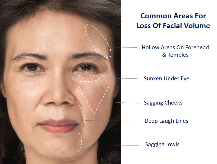 common concerns related to facial volume loss