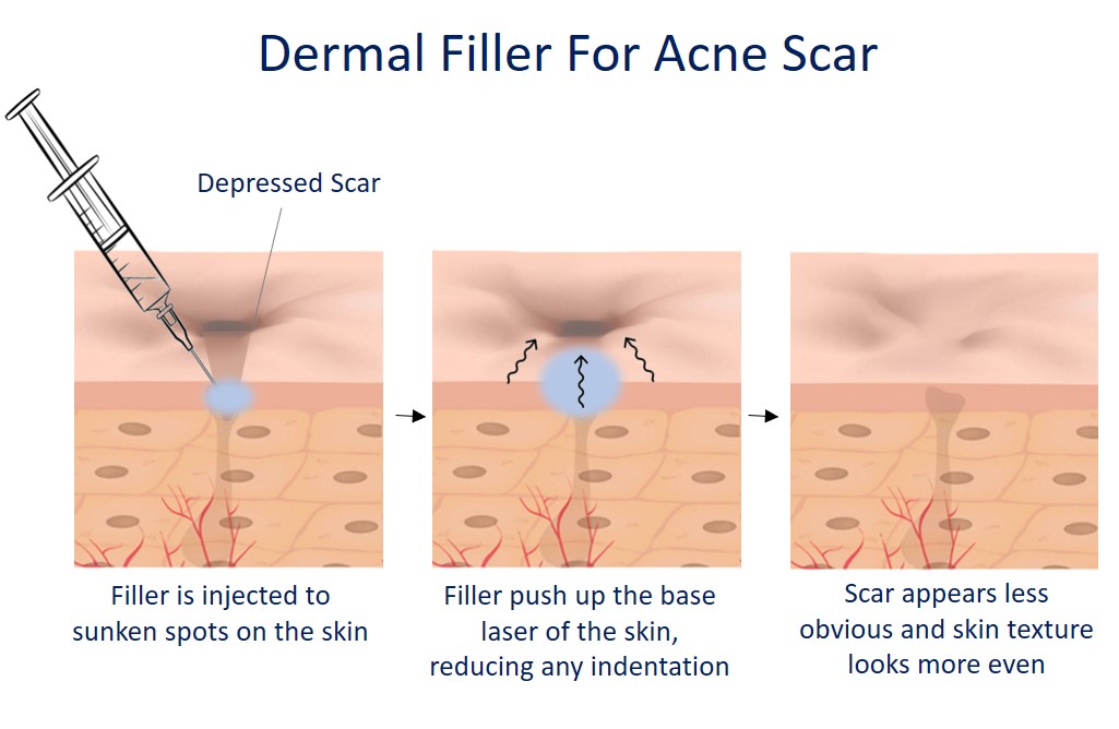 dermal fillers for acne scar - how it works