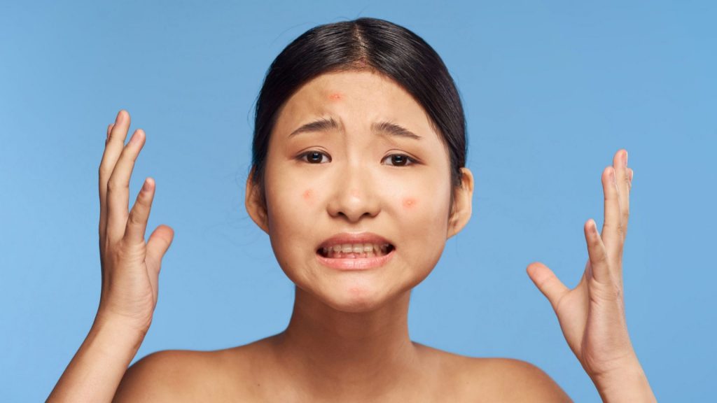 finding the right acne scar treatments in singapore