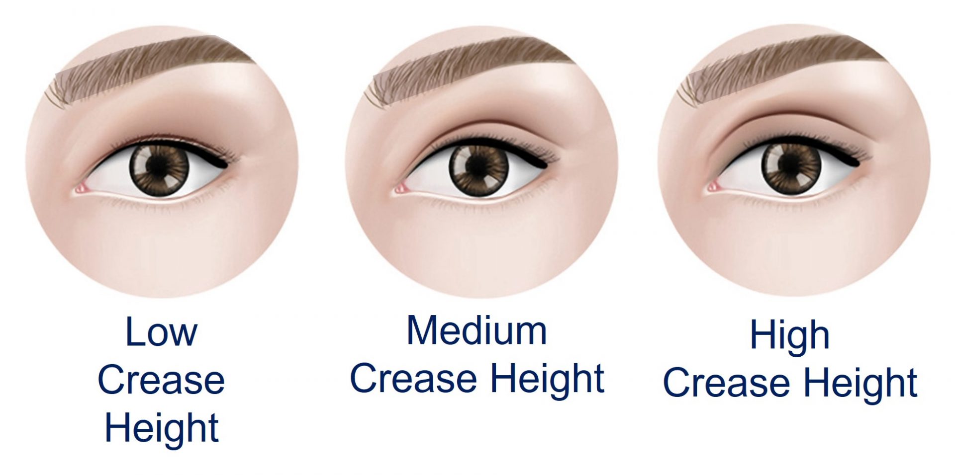 options for double eyelid crease height