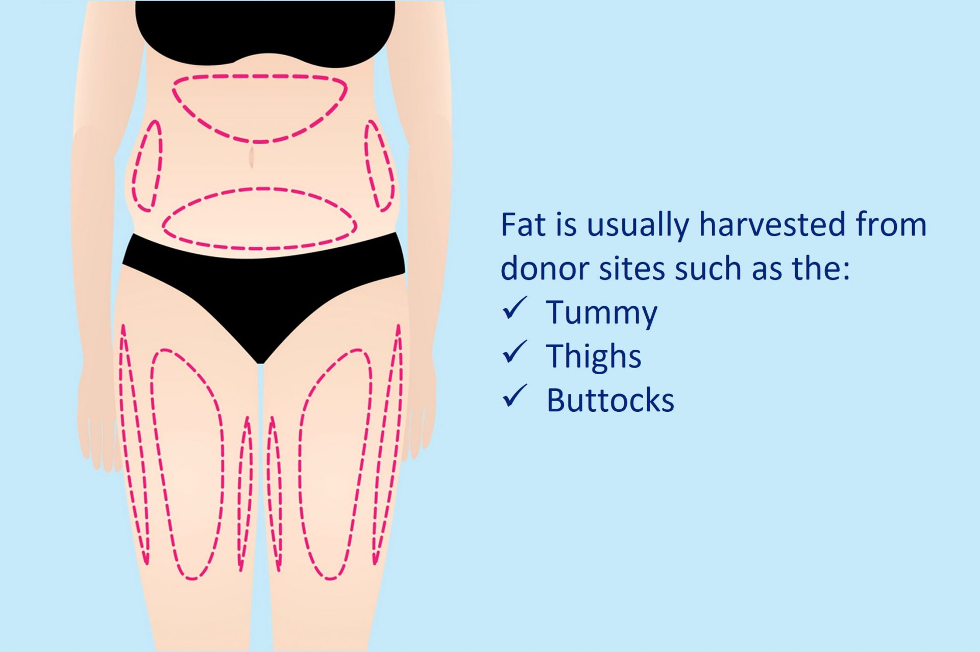 fat donor sites for breast fat grafting