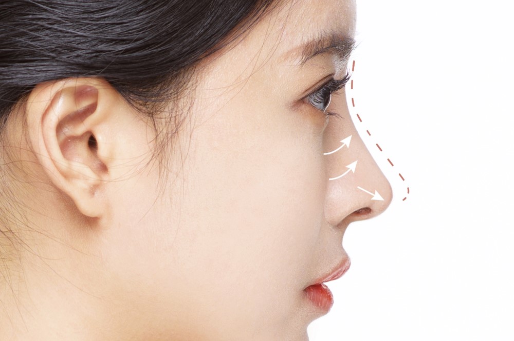 How To Correct The Shape Of The Nose With Dermal Filler Injections