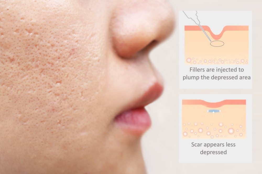 fillers for acne scar rejuvenation