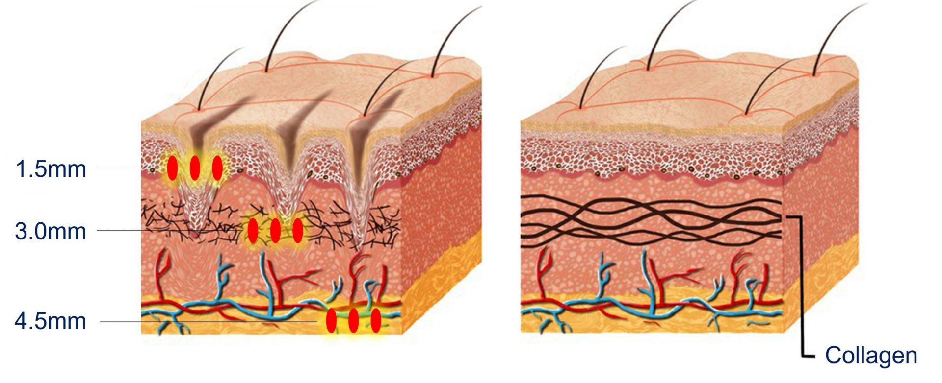 hifu treatment for skin tightening mechanism