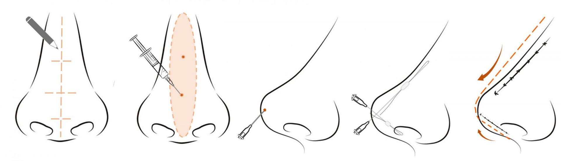 hiko nose thread lift procedure steps