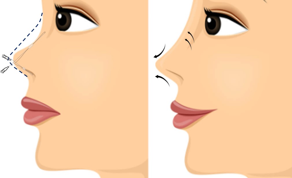 hiko nose thread lift - how dies it work for nose enhancement